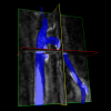 Arteriovenous Fistula