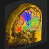 Brain MRI Example