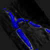 Arteriovenous Fistula